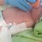 Ventilazione non invasiva su una neonata: prima volta all’ospedale di Foligno